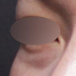 눈밑꺼짐필러 전후, 짙은 다크서클까지 심했던 케이스(ft. 시술 후 부작용)