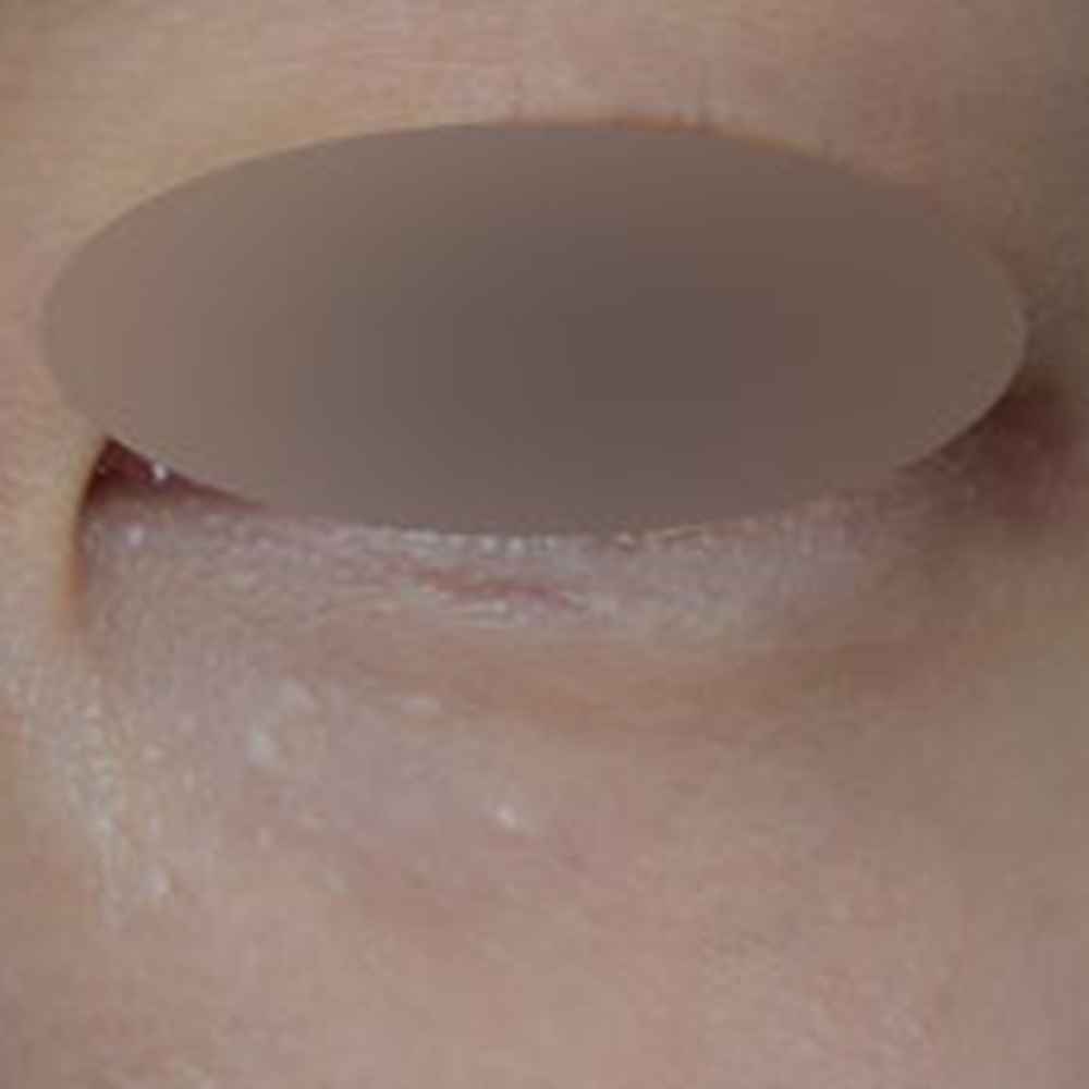 눈가 비립종 제거, 미세절연침 레이저를 활용한 케이스