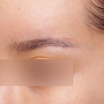 엘란쎄필러 효과, 눈썹꺼짐 개선도 가능하다?