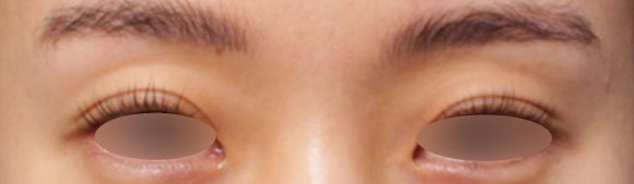 눈꺼풀꺼짐, 눈꺼풀패임 필러 시술로 개선한 케이스