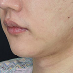 남자 이중턱 실리프팅, 여성분 시술과는 이런 점이 다릅니다.