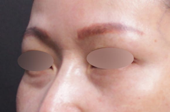 눈밑꺼짐필러 전후, 짙은 다크서클까지 심했던 케이스(ft. 시술 후 부작용)