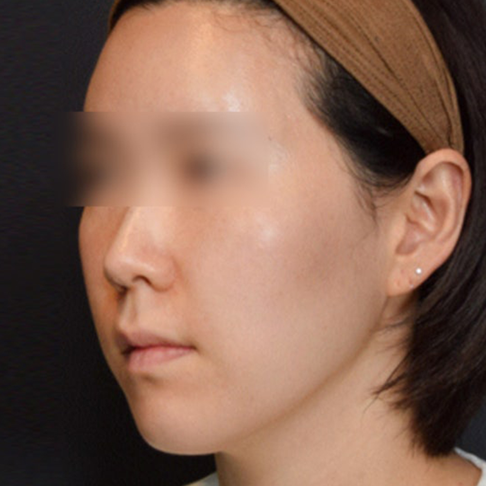 비절개 광대축소 시술, 광대축소 실리프팅을 소개합니다.