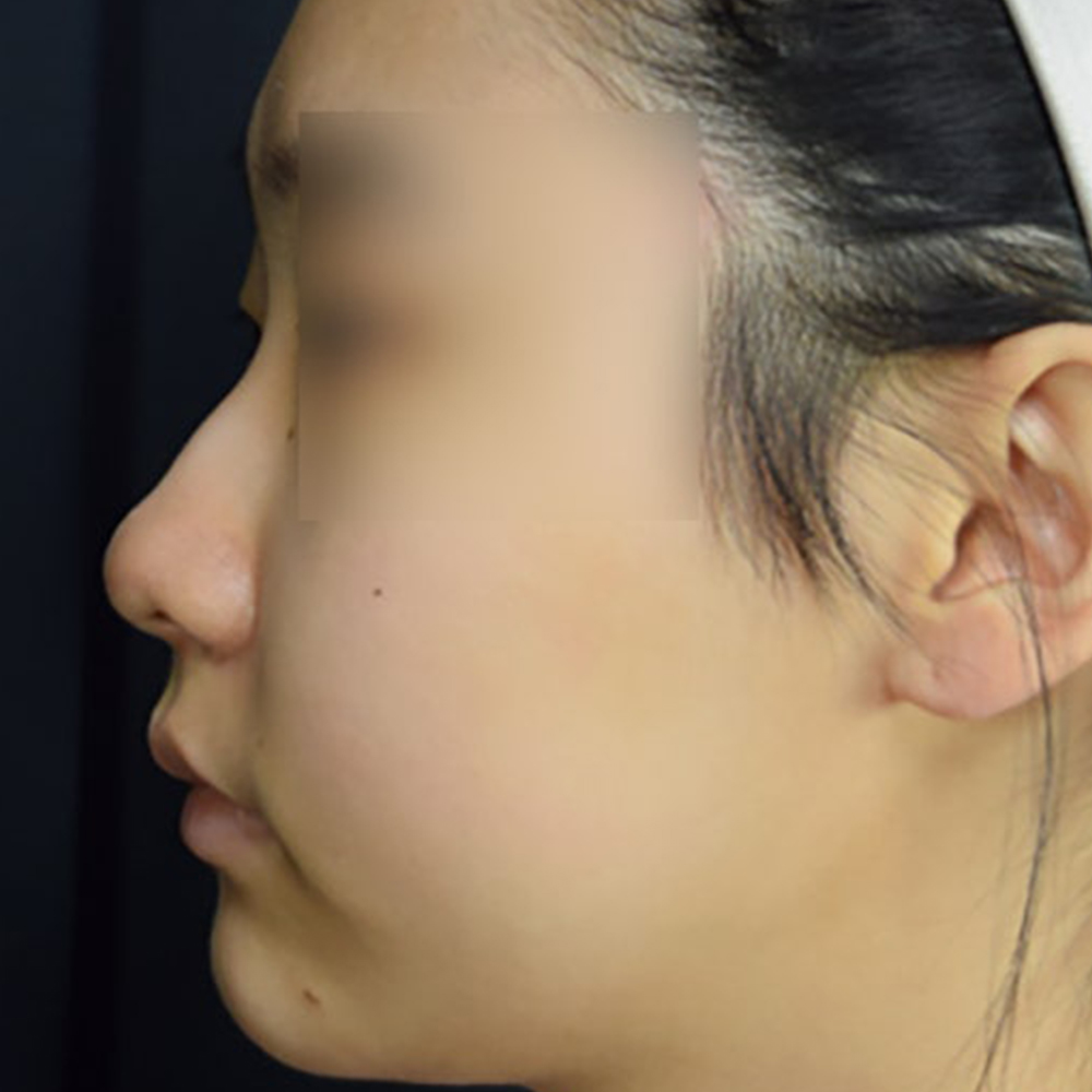 엘란쎄 코필러, 콧대 코끝까지 전체적인 교정 (ft. 진주도도코)