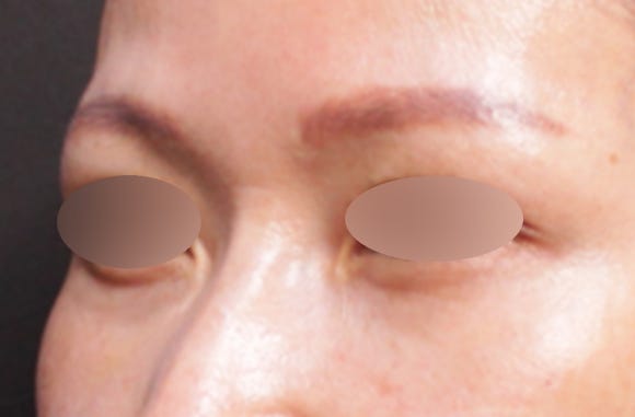 눈밑꺼짐필러 전후, 짙은 다크서클까지 심했던 케이스(ft. 시술 후 부작용)