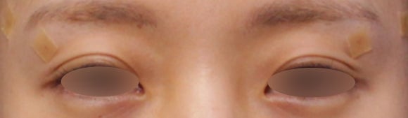 눈꺼풀꺼짐, 눈꺼풀패임 필러 시술로 개선한 케이스