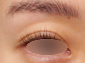 눈꺼풀꺼짐, 눈꺼풀패임 필러 시술로 개선한 케이스