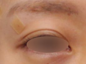 눈꺼풀꺼짐, 눈꺼풀패임 필러 시술로 개선한 케이스