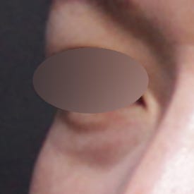 눈밑꺼짐필러 전후, 짙은 다크서클까지 심했던 케이스(ft. 시술 후 부작용)