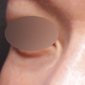 눈밑꺼짐필러 전후, 짙은 다크서클까지 심했던 케이스(ft. 시술 후 부작용)