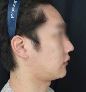 남자 이중턱 실리프팅, 여성분 시술과는 이런 점이 다릅니다.