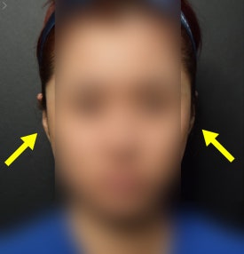 누운귀 필러, 시술 후 변화를 보여드립니다.