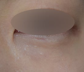 눈가 비립종 제거, 미세절연침 레이저를 활용한 케이스