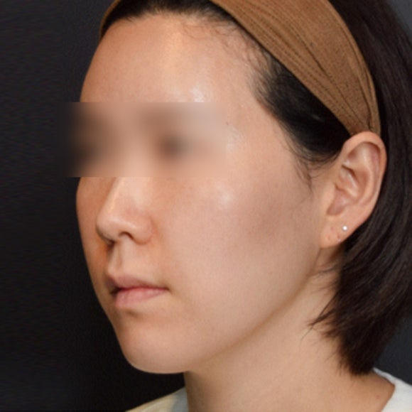 비절개 광대축소 시술, 광대축소 실리프팅을 소개합니다.