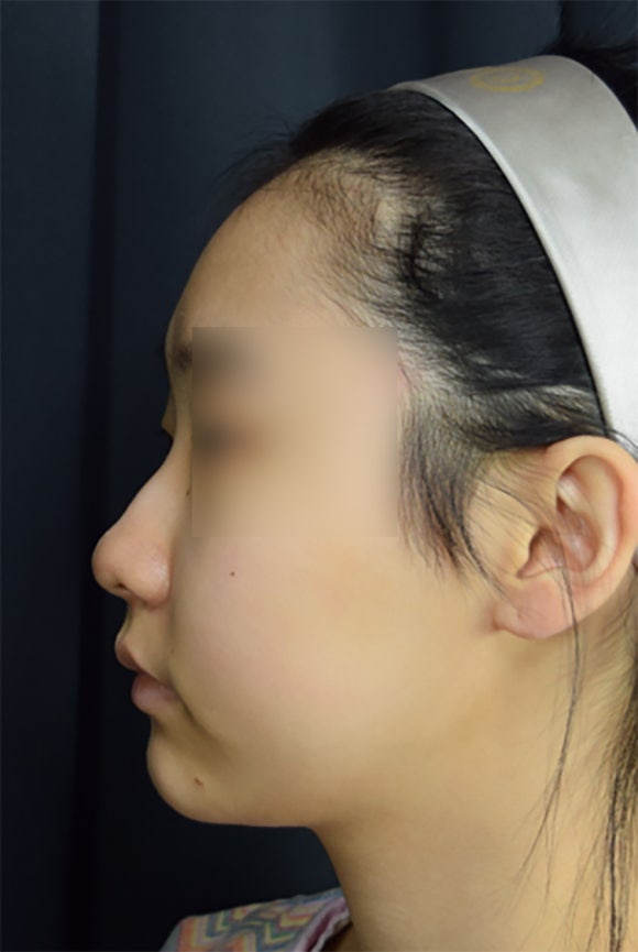 엘란쎄 코필러, 콧대 코끝까지 전체적인 교정 (ft. 진주도도코)