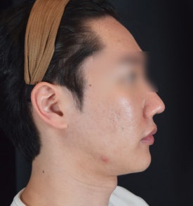 남자 이중턱 실리프팅, 여성분 시술과는 이런 점이 다릅니다.