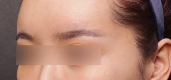 엘란쎄필러 효과, 눈썹꺼짐 개선도 가능하다?