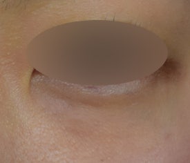 눈가 비립종 제거, 미세절연침 레이저를 활용한 케이스