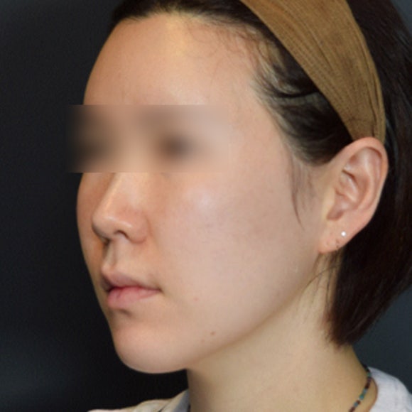 비절개 광대축소 시술, 광대축소 실리프팅을 소개합니다.