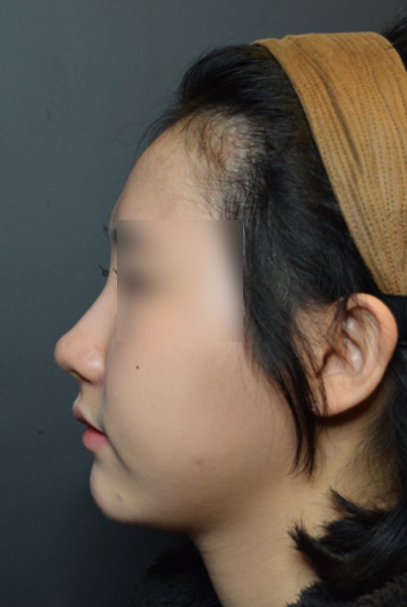 엘란쎄 코필러, 콧대 코끝까지 전체적인 교정 (ft. 진주도도코)