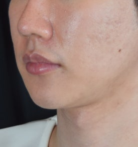 남자 이중턱 실리프팅, 여성분 시술과는 이런 점이 다릅니다.