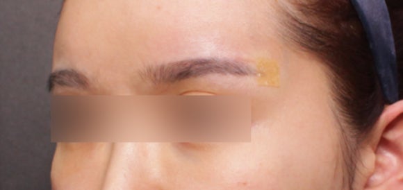 엘란쎄필러 효과, 눈썹꺼짐 개선도 가능하다?