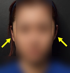 누운귀 필러, 시술 후 변화를 보여드립니다.