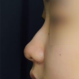 엘란쎄 코필러, 콧대 코끝까지 전체적인 교정 (ft. 진주도도코)