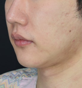 남자 이중턱 실리프팅, 여성분 시술과는 이런 점이 다릅니다.