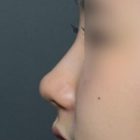 엘란쎄 코필러, 콧대 코끝까지 전체적인 교정 (ft. 진주도도코)