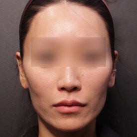 땅콩형 얼굴 시술, 필러? 리프팅?