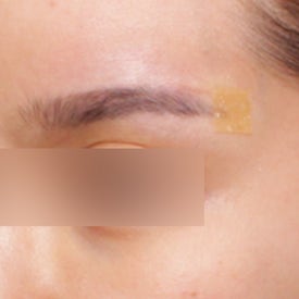 엘란쎄필러 효과, 눈썹꺼짐 개선도 가능하다?