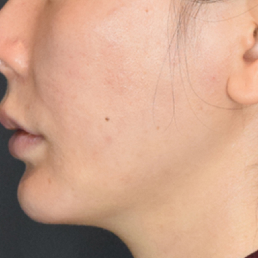 턱선 필러, 엘란쎄를 활용한 방법도 있습니다.