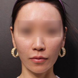 땅콩형 얼굴 시술, 필러? 리프팅?