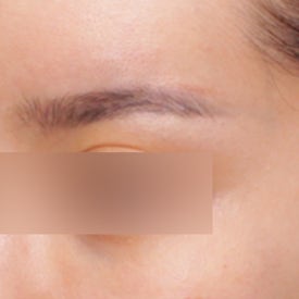 엘란쎄필러 효과, 눈썹꺼짐 개선도 가능하다?