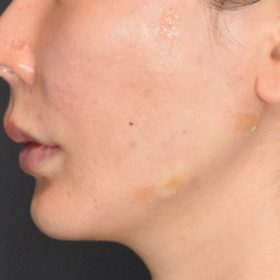 턱선 필러, 엘란쎄를 활용한 방법도 있습니다.