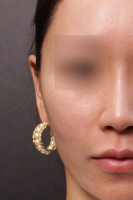 땅콩형 얼굴 시술, 필러? 리프팅?