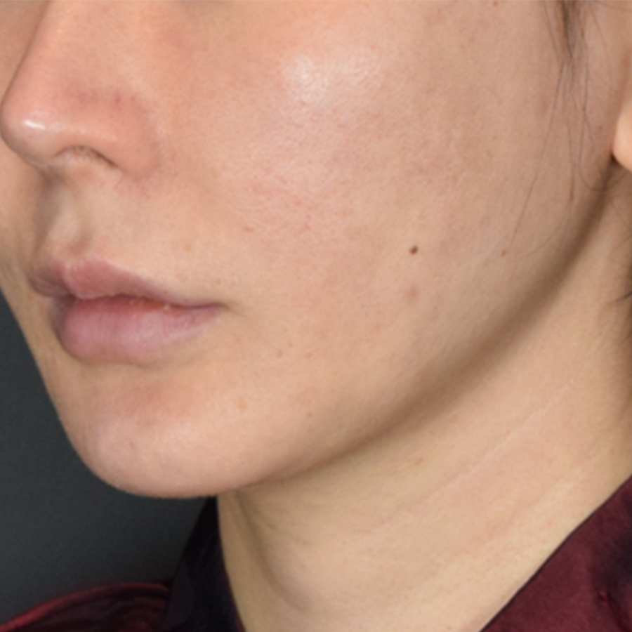 턱선 필러, 엘란쎄를 활용한 방법도 있습니다.