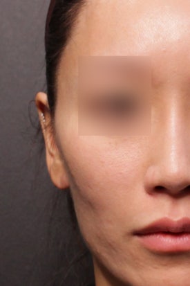 땅콩형 얼굴 시술, 필러? 리프팅?