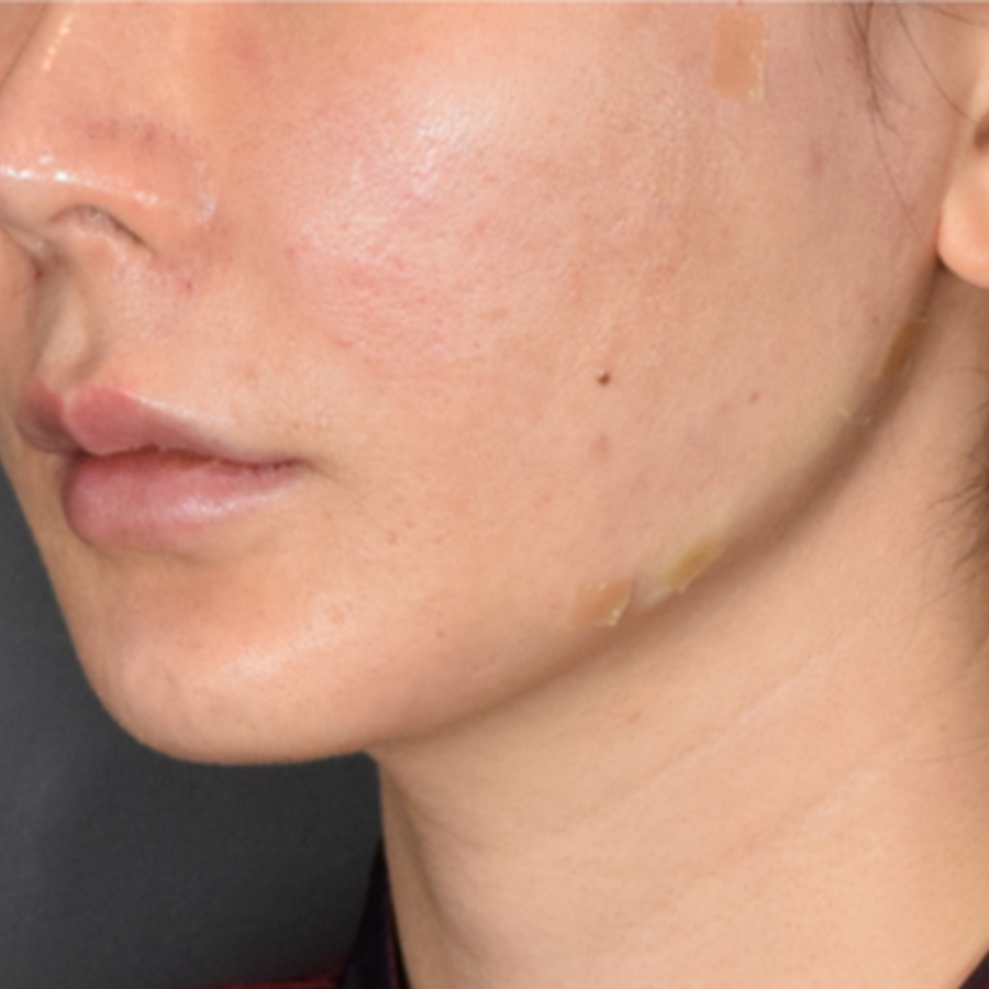 턱선 필러, 엘란쎄를 활용한 방법도 있습니다.