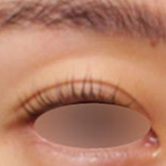 눈꺼풀꺼짐, 눈꺼풀패임 필러 시술로 개선한 케이스