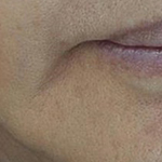 마리오네트 주름, 필러 대신 콜라겐주사 시술