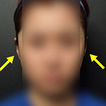 누운귀 필러, 시술 후 변화를 보여드립니다.