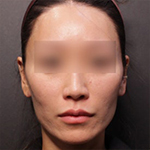 땅콩형 얼굴 시술, 필러? 리프팅?