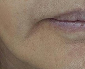 마리오네트 주름, 필러 대신 콜라겐주사 시술