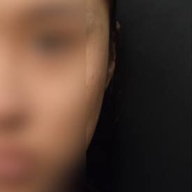 누운귀 필러, 시술 후 변화를 보여드립니다.