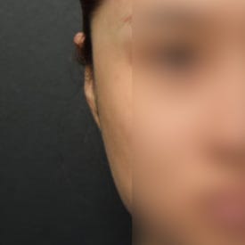 누운귀 필러, 시술 후 변화를 보여드립니다.