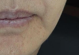 마리오네트 주름, 필러 대신 콜라겐주사 시술