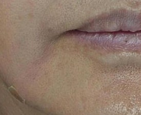 마리오네트 주름, 필러 대신 콜라겐주사 시술