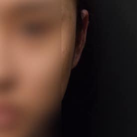 누운귀 필러, 시술 후 변화를 보여드립니다.